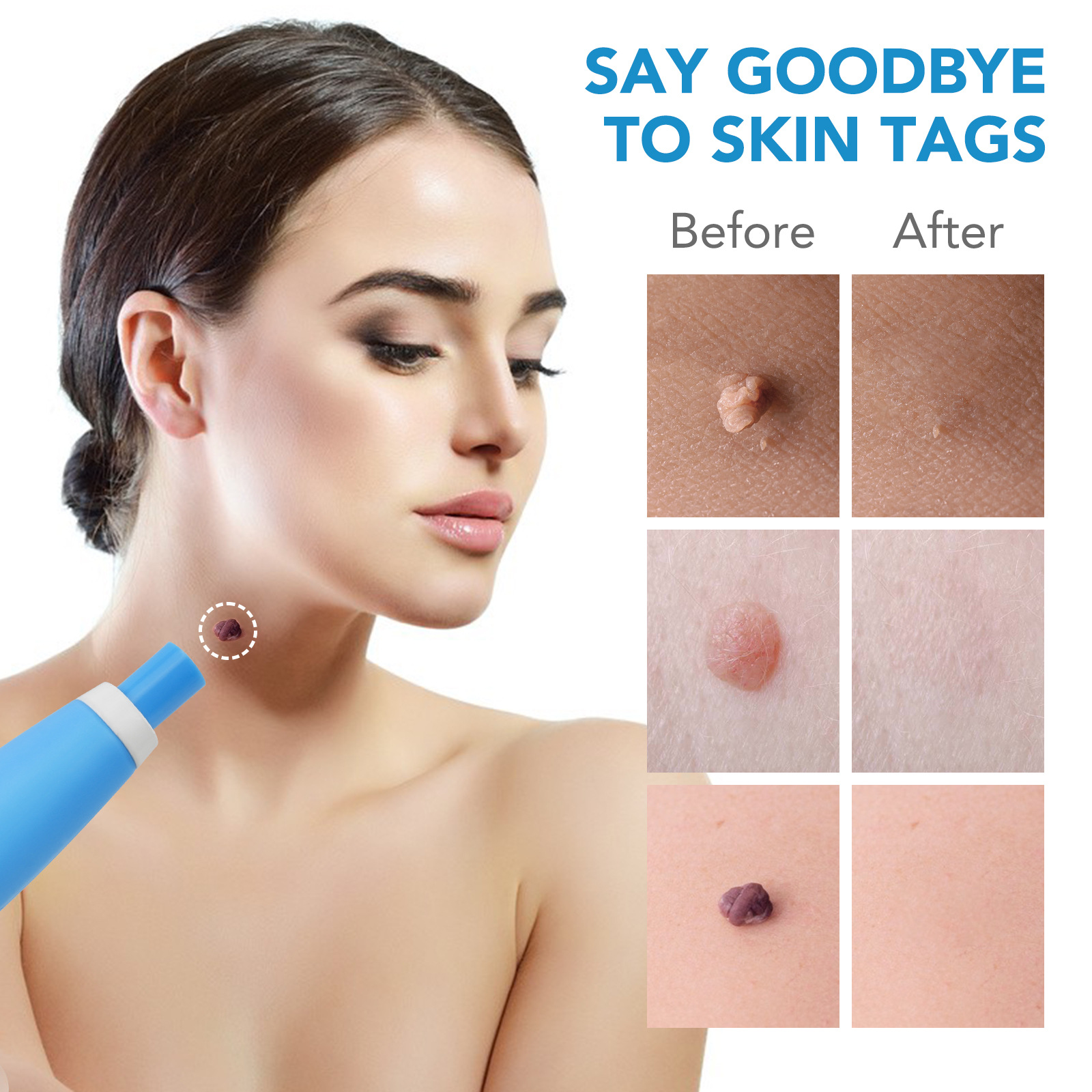 Auto Skin Tag Removal Kit For  - Home Improvement Kit incelemesi ve fiyatı